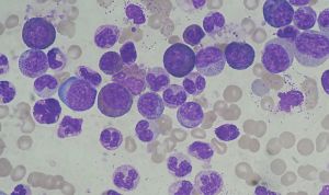 Descubierto el desarrollo genético de una de las leucemias más agresivas