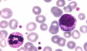 Descubren la forma de mejorar los trasplantes hematopoyéticos en leucemia