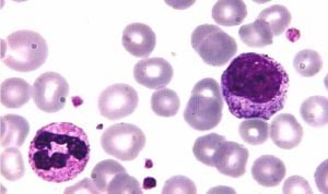 Descubren la forma de mejorar los trasplantes hematopoyéticos en leucemia