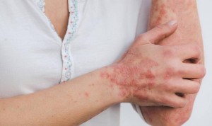 Descubren las 3 proteínas que generan la psoriasis y cómo paralizarlas