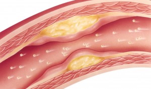 Descubren por qué los fármacos contra el colesterol generan dolor muscular