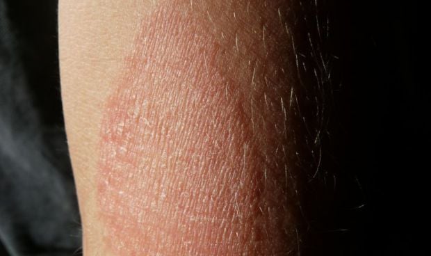 Descubren qué causa la piel seca e inflamada en pacientes con eczema