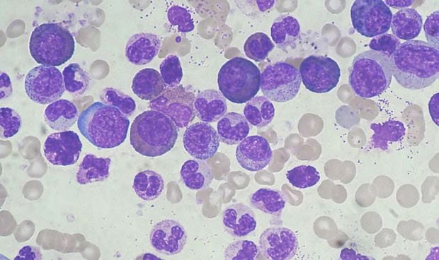 Descubren un mecanismo que inhibe y destruye células madre de la leucemia