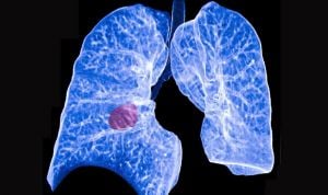 Descubren un nuevo tipo de cáncer de pulmón de células pequeñas