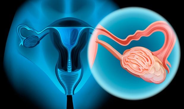 Exámenes de detección del cáncer de ovario, de trompas de Falopio y primario de peritoneo (PDQ®)–Versión para pacientes