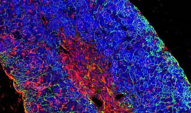 Descubren una nueva diana terapéutica para la leucemia linfoblástica aguda