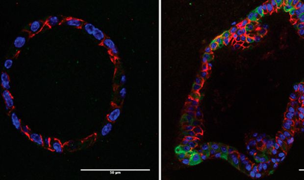 Descubren una terapia que dificulta las recadas en el cncer de mama 