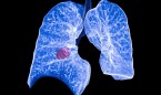 Descubren una vía del cáncer de pulmón para hacerse resistente