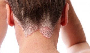 Desmintiendo los bulos de la psoriasis: "Ni se cura, ni se pega"