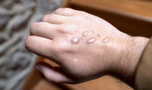 Detectado un nuevo brote de Mpox con un origen que "no está claro"