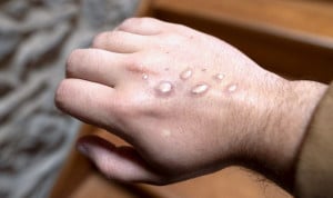  Una persona afectada por Mpox.