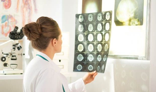 Detectan actividad epiléptica en pacientes de alzhéimer tardío 