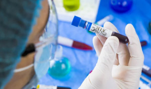 Detectan el tercer caso mundial de cura funcional del VIH sin tratamiento