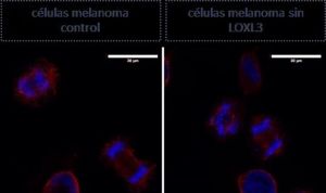 Detectan la proteína que las células del melanoma necesitan para sobrevivir