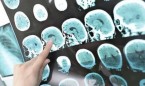 Detectan por primera vez 5 casos en el mundo de alzhéimer por transmisión