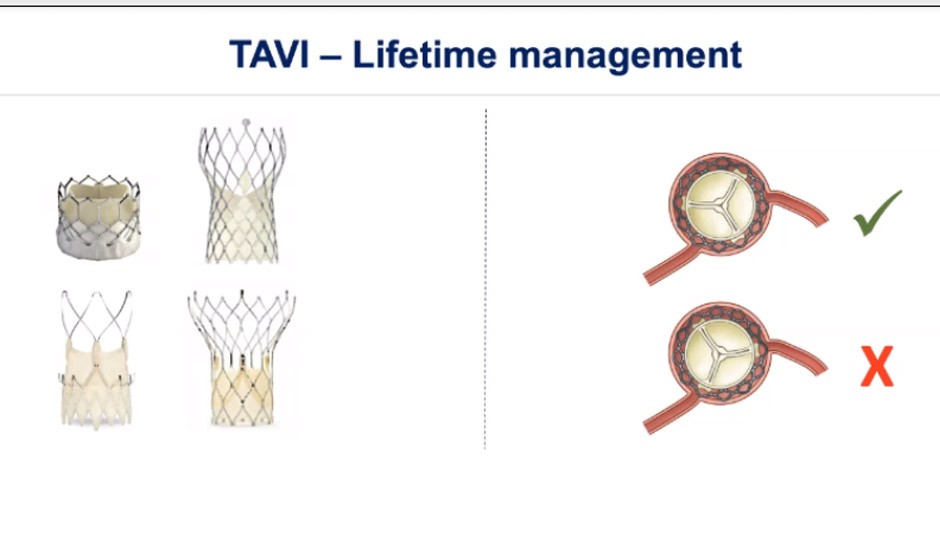 Diseño y colocación de la válvula, claves en el reacceso coronario en TAVI