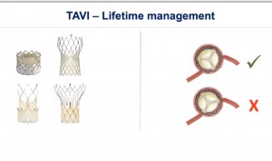 Diseño y colocación de la válvula, claves en el reacceso coronario en TAVI