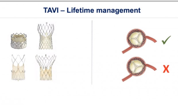 Diseño y colocación de la válvula, claves en el reacceso coronario en TAVI