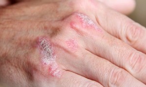 Doble aval para Tremfya (Janssen) como terapia en artritis psoriásica