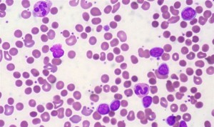 Dos nuevas terapias retrasan la progresión de la leucemia pediátrica