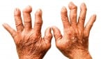 Dos nuevos fármacos en artritis reumatoide se muestran eficaces y seguros