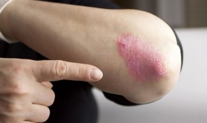 El 57% de pacientes con psoriasis no consigue blanquear sus lesiones