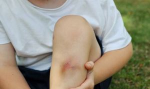 El 90% de los menores maltratados presentan lesiones en la piel