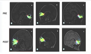 El aprendizaje musical crea neuronas que mejoran el TDAH