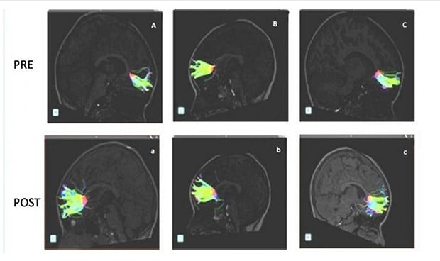 El aprendizaje musical crea neuronas que mejoran el TDAH