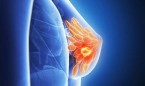 El binomio IA-resonancia magnética mejora el diagnóstico en cáncer de mama