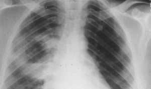 El bloqueo de una interleuquina revierte la fibrosis pulmonar en ratones