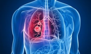 El cáncer de pulmón, "nuevo paradigma" de la medicina de precisión