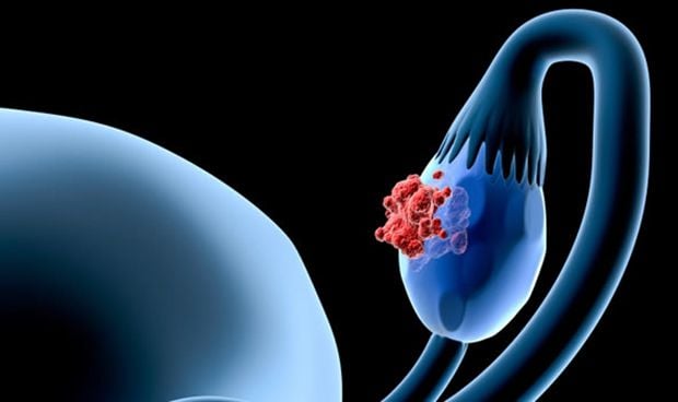 El cribado de cncer de ovario no es aconsejable en mujeres sin sntomas