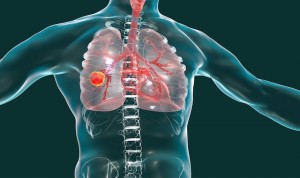 El cribado temprano de cáncer de pulmón aumenta la supervivencia a un 80%