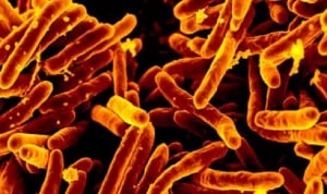 El CSIC constata diferencias en la transmisión de tuberculosis entre países