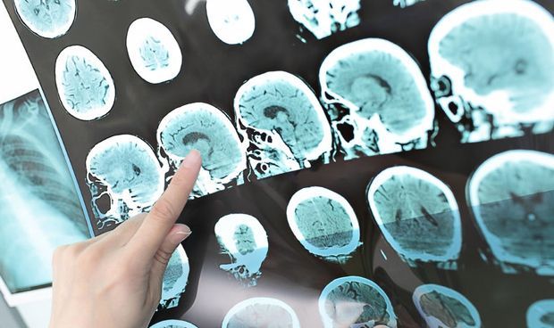 El CSIC halla una molécula con potencial terapéutico para el Alzheimer