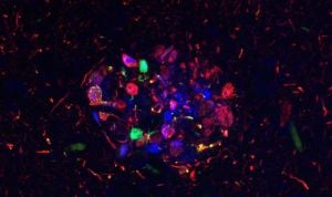 El CSIC muestra que el alzhéimer varía según cada paciente 