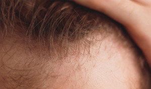 El 'cultivo' de folículos capilares naturales acerca el fin de la calvicie