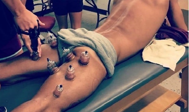 El 'cupping', una tendencia al alza sin ninguna evidencia científica