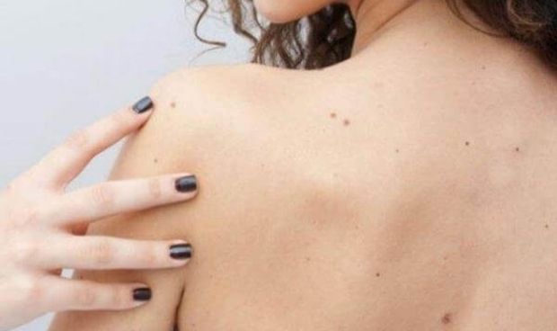 El diagnóstico tardío del melanoma puede tener una mortalidad de un 60%