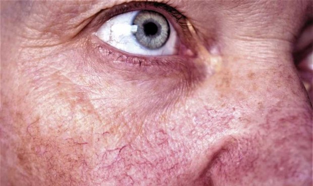 El eritema facial y la telangiectasia responden mal al tratamiento de luz