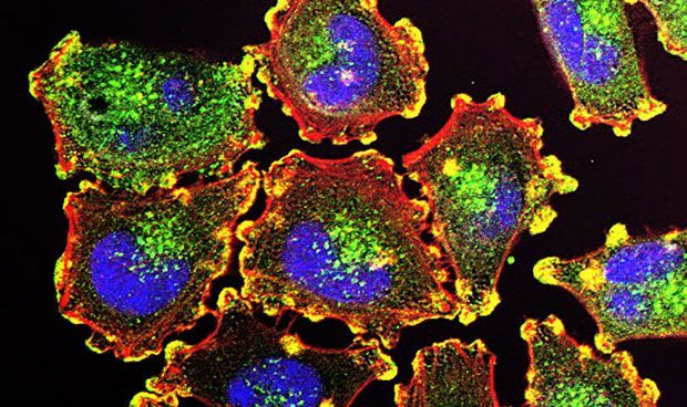 El melanoma es uno de los tumores de mayor crecimiento en los últimos años