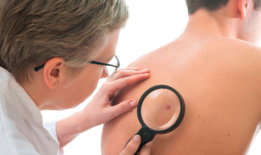 El melanoma supone el 4% de los cánceres cutáneos y el 75% de las muertes