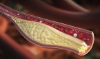 El microRNA miR-125b fomenta la aterosclerosis en pacientes coronarios