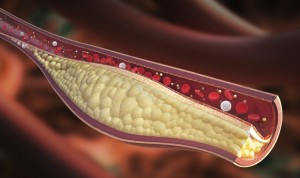 El microRNA miR-125b fomenta la aterosclerosis en pacientes coronarios