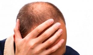 La terapia con plasma rico en plaquetas aporta beneficios en la pérdida del cabello, según ha informado la Academia Americana de Dermatología 