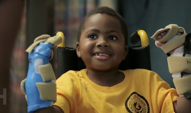 El primer niño con trasplante doble de manos evoluciona bien