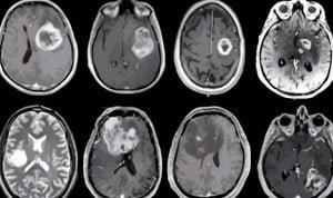 El retorno del ARN mensajero permite atacar al tumor cerebral más agresivo