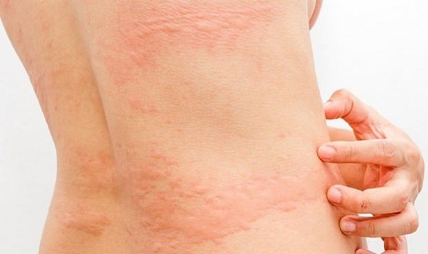 El riesgo de trastornos de la piel es mayor en las personas celiacas