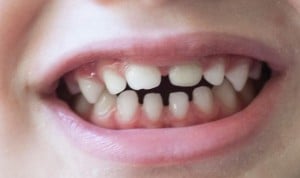 El TDAH y el autismo dejan su 'firma' en los dientes de leche